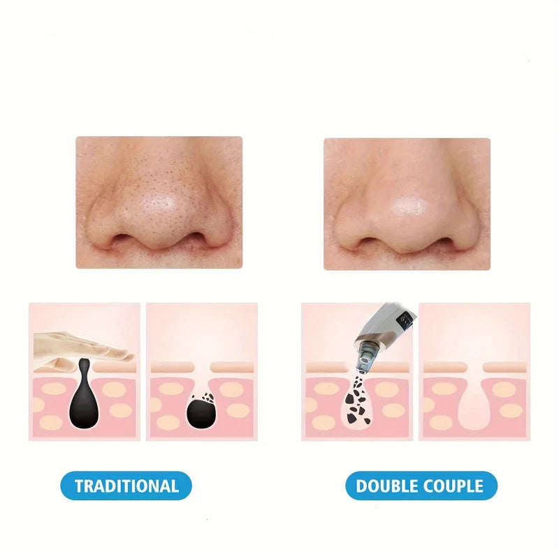 Blackhead Entferner Porenstaubsauger - 5 Saugmodi USB wiederaufladbares Gesichts-Porenreinigungsset